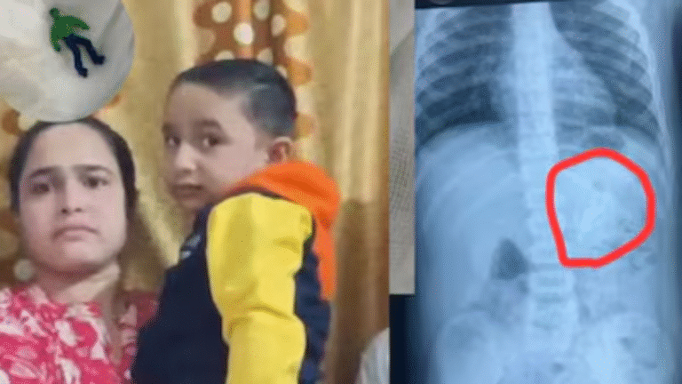 Medical Miracle in Ahmedabad Toddler Swallows ‘Hulk’